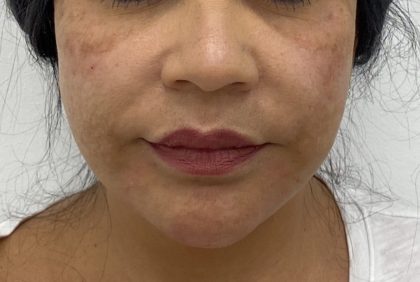 Facial Fillers Before & After Patient #1487