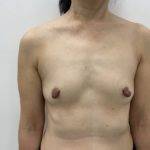 Fat Transfer Before & After Patient #1505