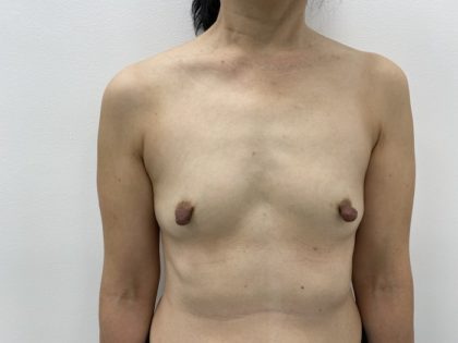 Fat Transfer Before & After Patient #1505