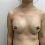 Fat Transfer Before & After Patient #1505