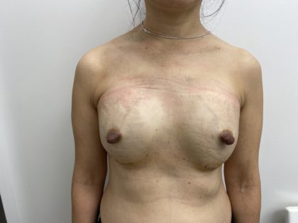 Fat Transfer Before & After Patient #1505