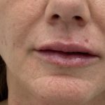 Lip Fillers Before & After Patient #1469