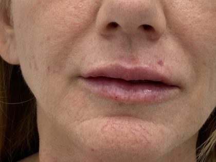 Lip Fillers Before & After Patient #1469