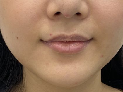 Lip Fillers Before & After Patient #1475