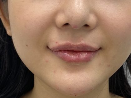Lip Fillers Before & After Patient #1475