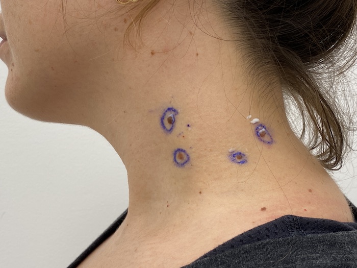 Mole Removal Before & After Patient #1466