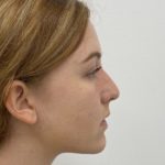 Non-Surgical Rhinoplasty Before & After Patient #1481