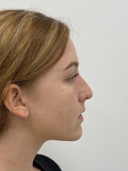 Non-Surgical Rhinoplasty Before & After Patient #1481