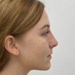 Non-Surgical Rhinoplasty Before & After Patient #1481