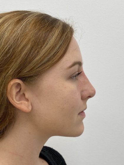 Non-Surgical Rhinoplasty Before & After Patient #1481