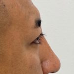 Non-Surgical Rhinoplasty Before & After Patient #1544