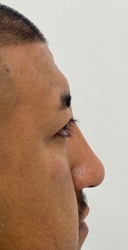 Non-Surgical Rhinoplasty Before & After Patient #1544