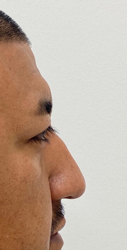 Non-Surgical Rhinoplasty Before & After Patient #1544