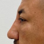 Non-Surgical Rhinoplasty Before & After Patient #1544