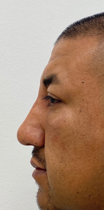 Non-Surgical Rhinoplasty Before & After Patient #1544