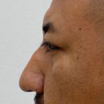 Non-Surgical Rhinoplasty Before & After Patient #1544