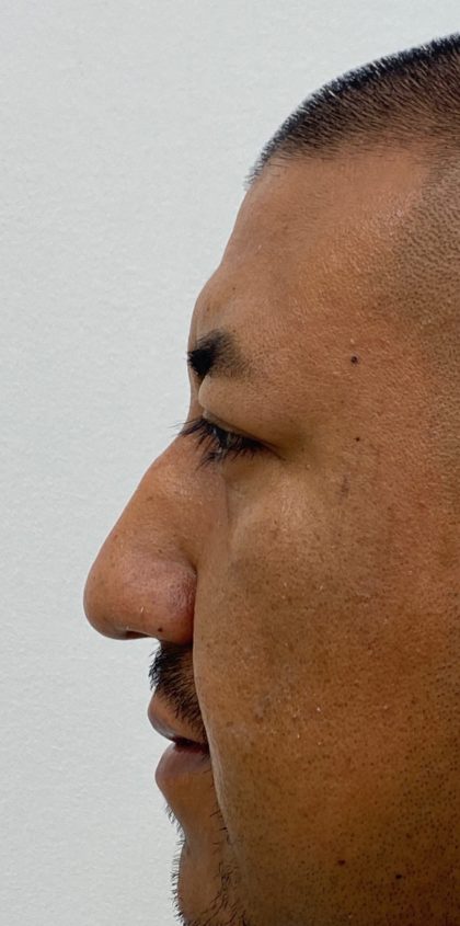 Non-Surgical Rhinoplasty Before & After Patient #1544