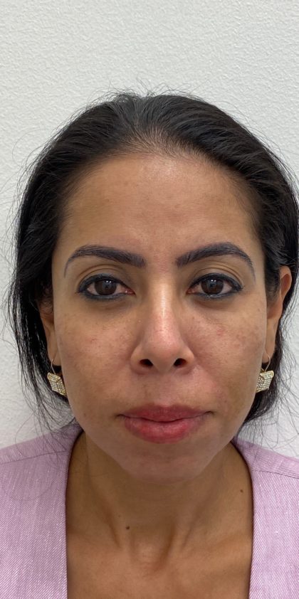 Facial Fillers Before & After Patient #1532