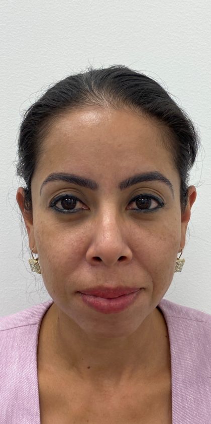Facial Fillers Before & After Patient #1532