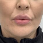 Lip Fillers Before & After Patient #1684