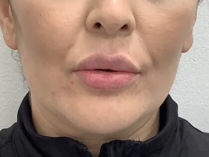 Lip Fillers Before & After Patient #1684