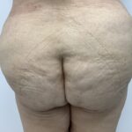 Fat Transfer Before & After Patient #1670