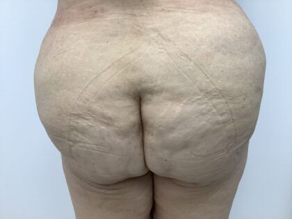 Fat Transfer Before & After Patient #1670