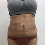 Liposculpture Before & After Patient #1680