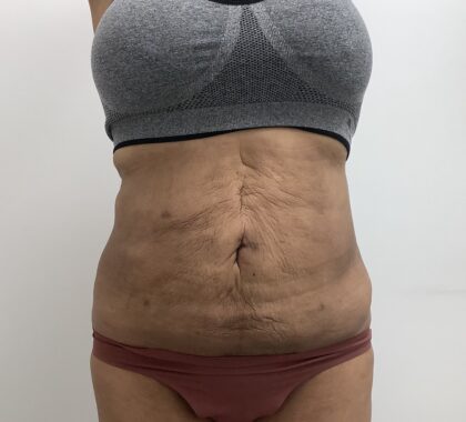 Liposculpture Before & After Patient #1680