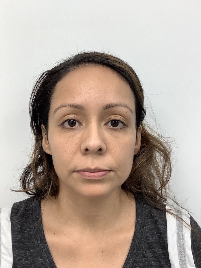 Facial Fillers Before & After Patient #1696