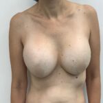 Breast Augmentation Before & After Patient #1673