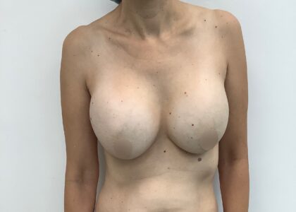 Breast Augmentation Before & After Patient #1673