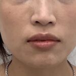 Lip Fillers Before & After Patient #1706