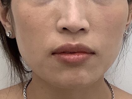 Lip Fillers Before & After Patient #1706