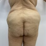 Fat Transfer Before & After Patient #1670