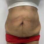 Liposculpture Before & After Patient #1680