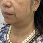 Non-Surgical Face & Neck Lift Before & After Patient #1711