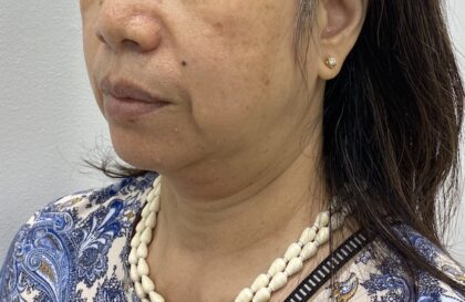 Non-Surgical Face & Neck Lift Before & After Patient #1711