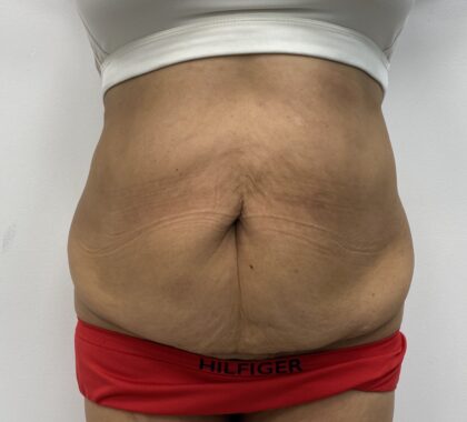 Liposculpture Before & After Patient #1680