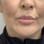 Lip Fillers Before & After Patient #1684