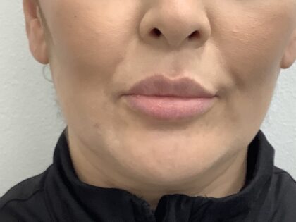 Lip Fillers Before & After Patient #1684