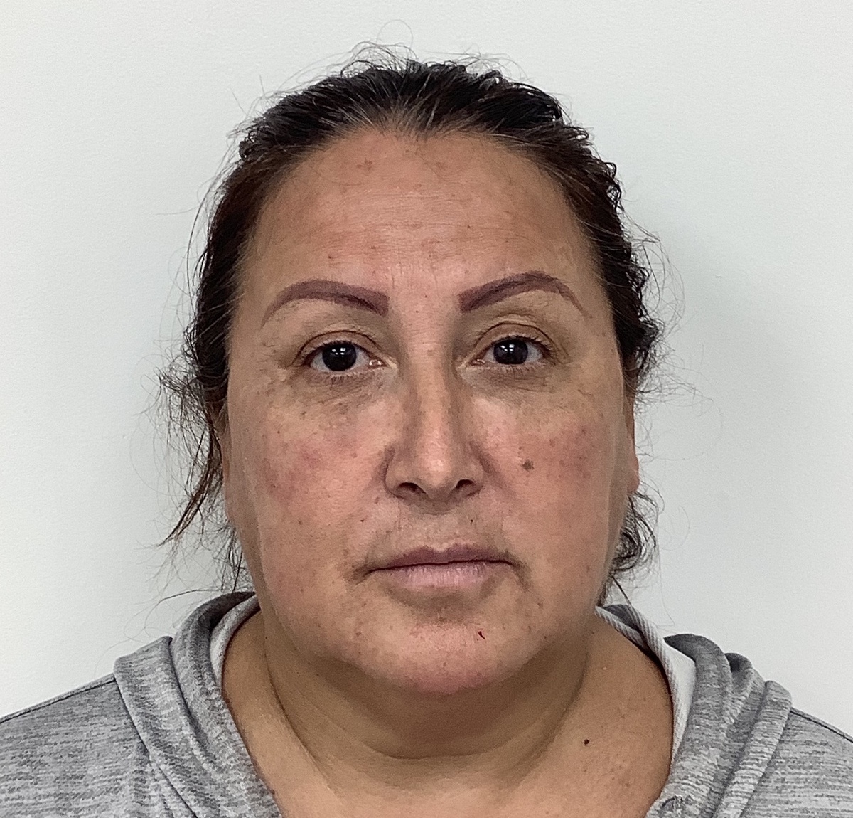 Facial Fillers Before & After Patient #1692