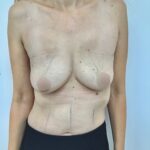 Breast Augmentation Before & After Patient #1673