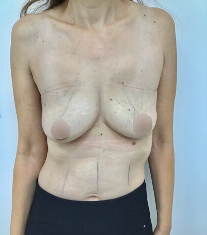 Breast Augmentation Before & After Patient #1673