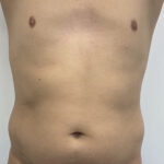 Liposculpture Before & After Patient #1737