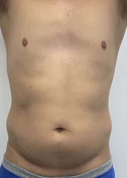 Liposculpture Before & After Patient #1737