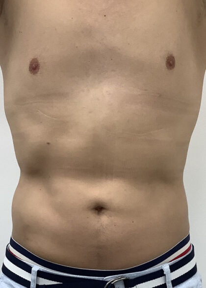 Liposculpture Before & After Patient #1737