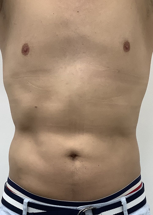 Liposculpture Before & After Patient #1737