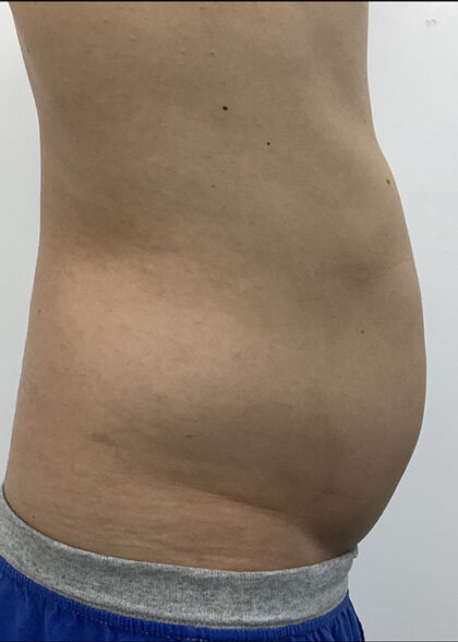 Liposculpture Before & After Patient #1737