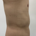 Liposculpture Before & After Patient #1737